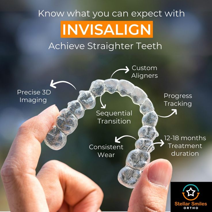 Invisalign consultation